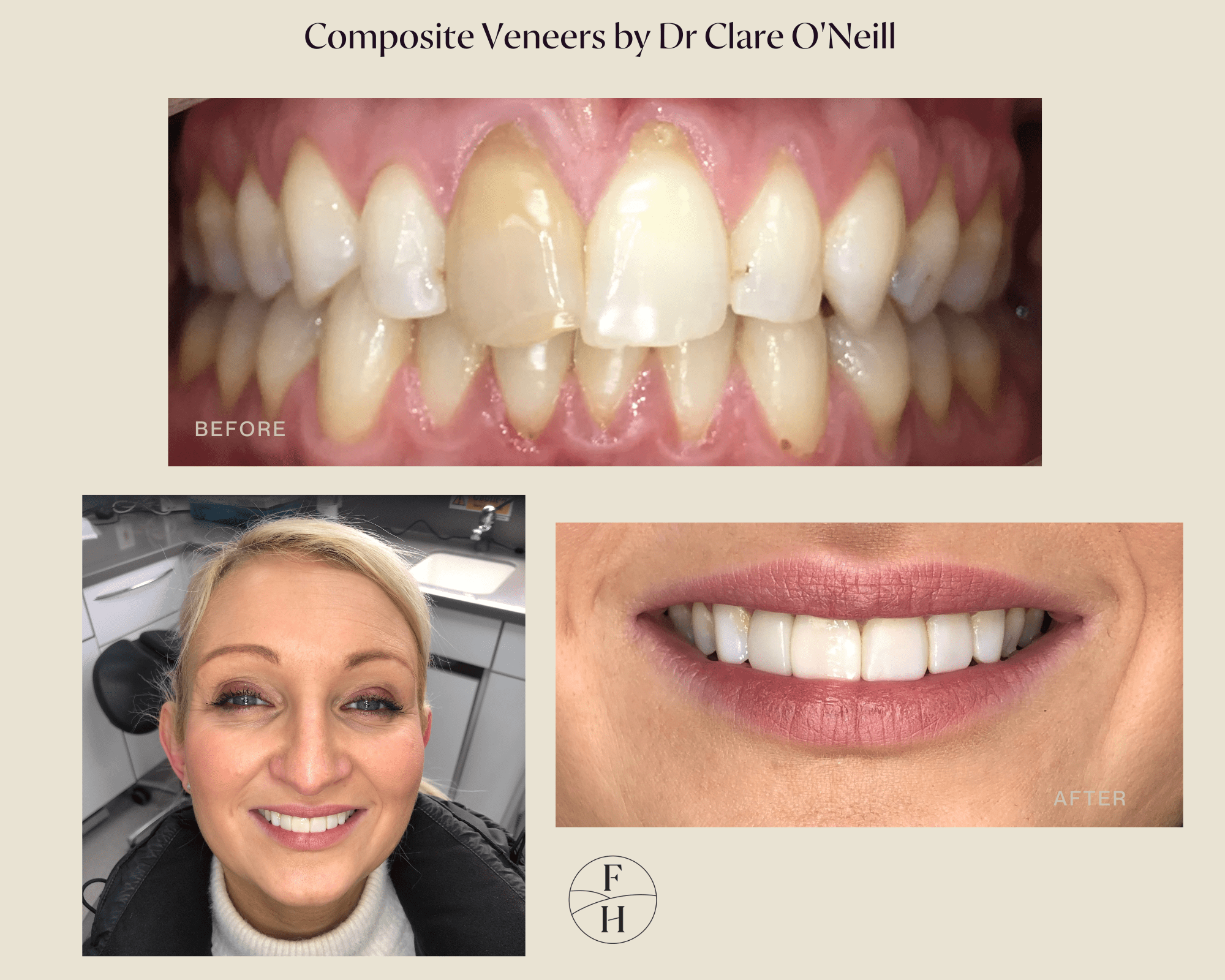 Composite Veneers Before and After 1