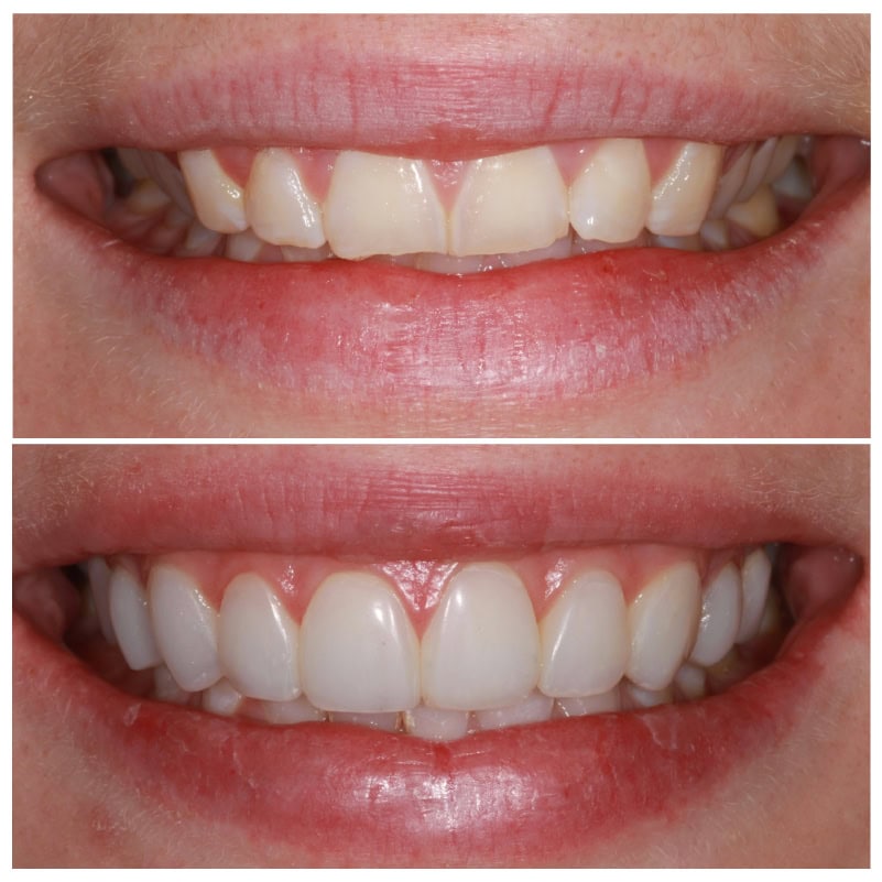 Invisalign Teeth Whitening and Veneers Leeds and York Rebecca before and after