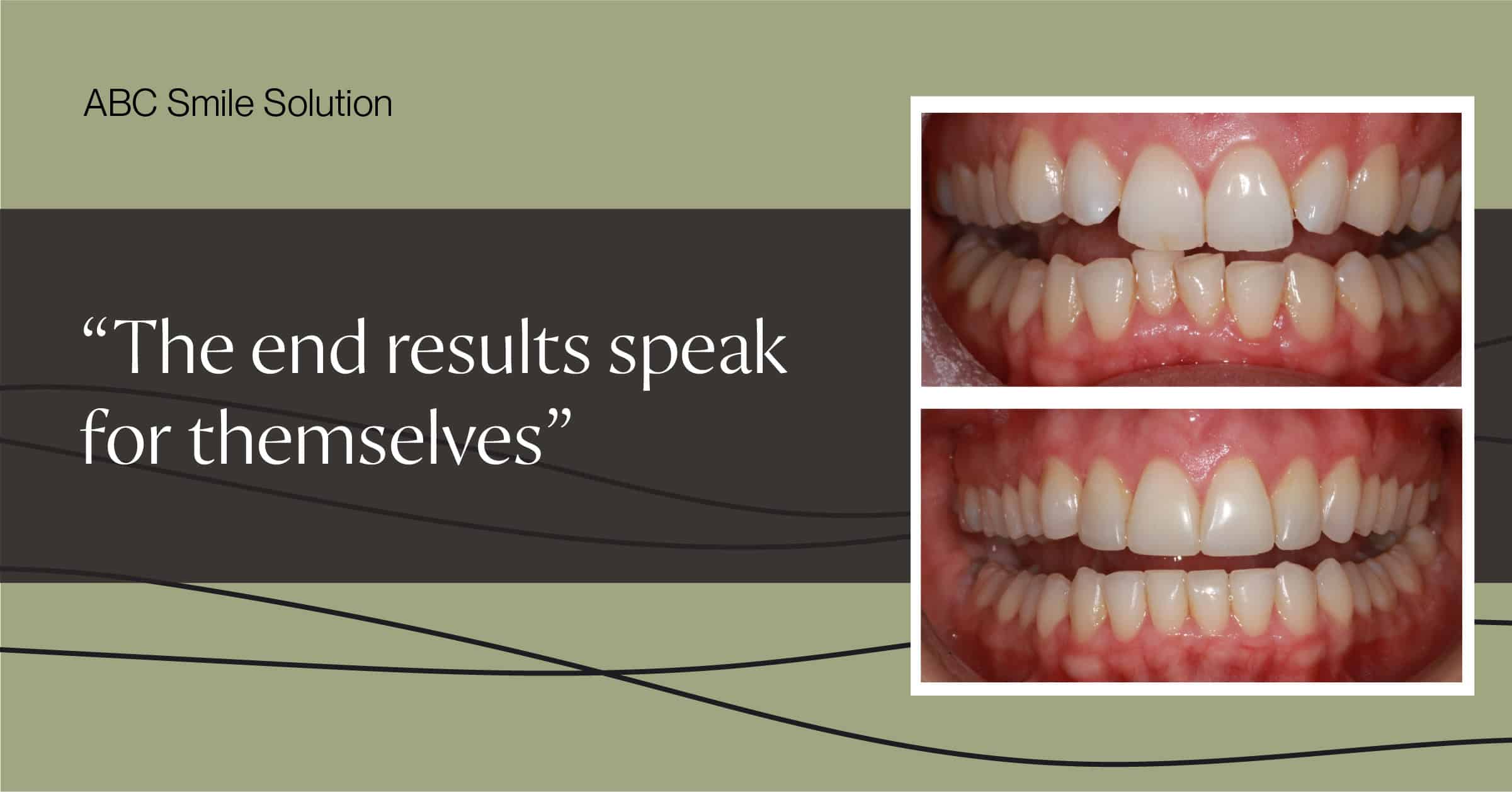 ABC Smile before and after results