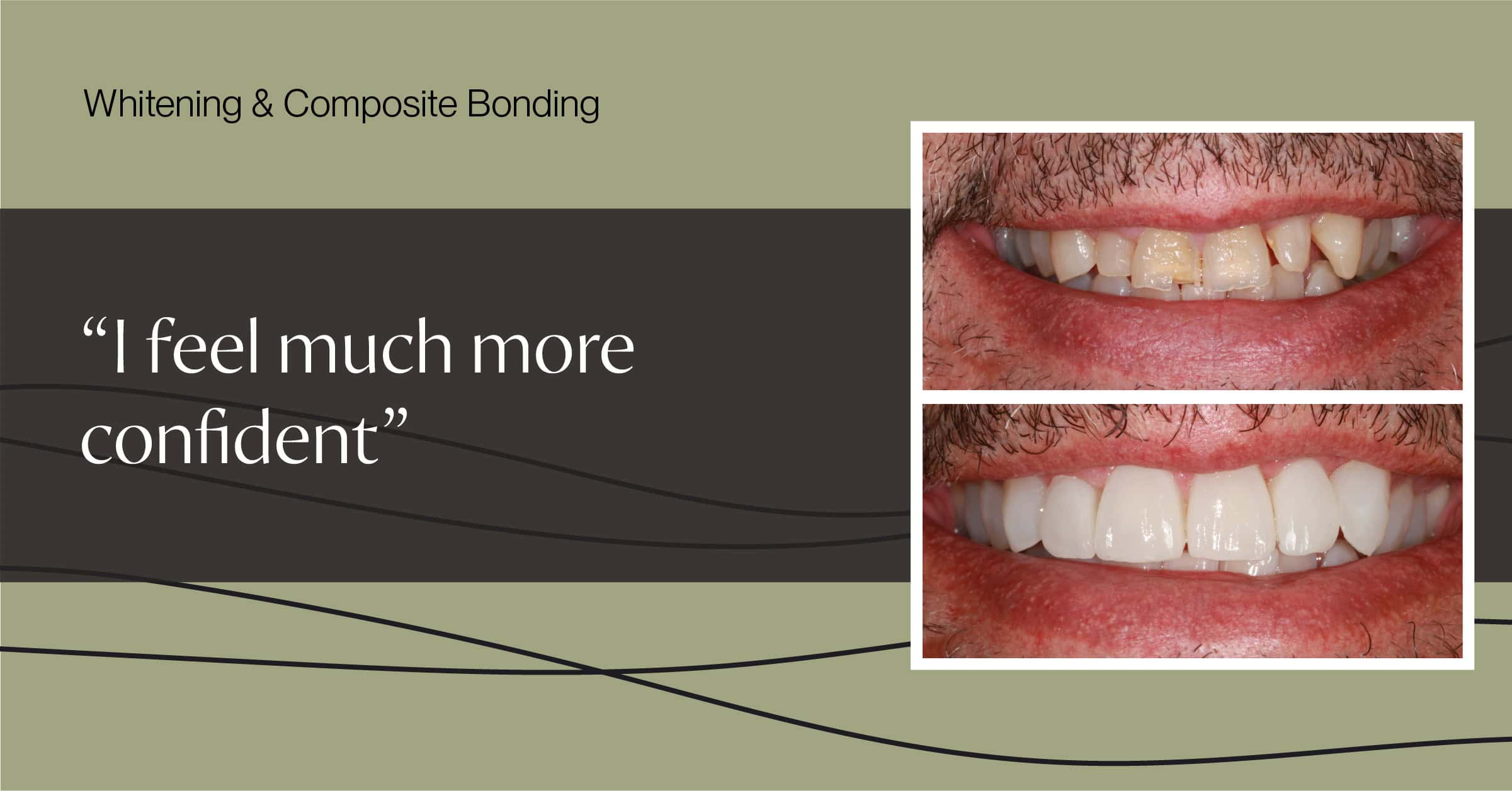 Whitening and Composite Bonding Martin