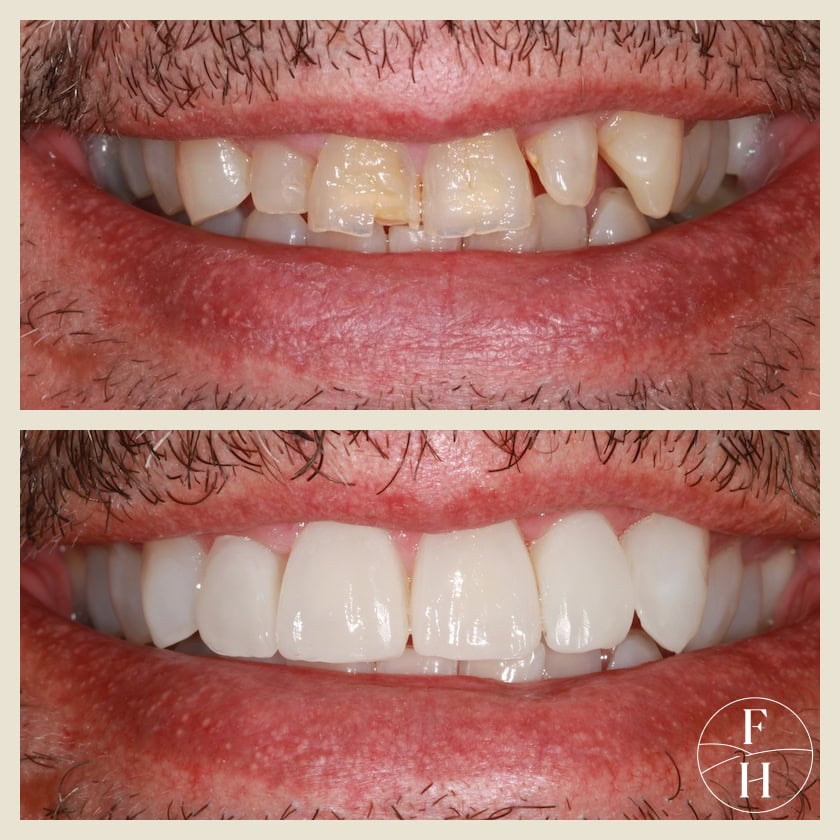 Teeth Whitening Leeds York before and after MGT2 Teeth Whitening Leeds York before and after MGT2